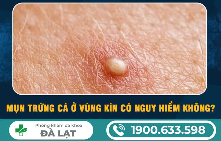 TẠI SAO LẠI MỌC MỤN TRỨNG CÁ TẠI VÙNG KÍN NỮ? 